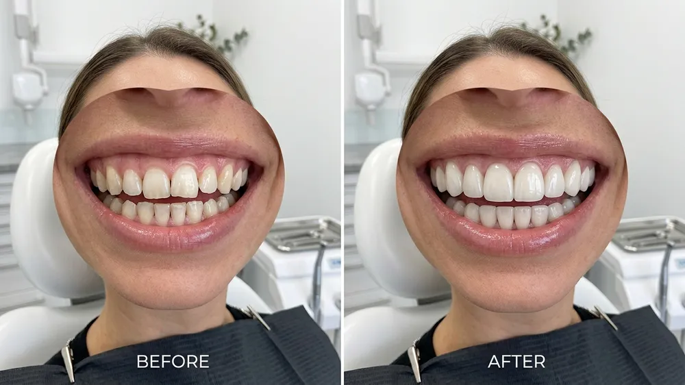 Before and after comparison of composite bonding vs porcelain veneers smile makeover at Dr. Shahid Islam Dental Clinic Karachi